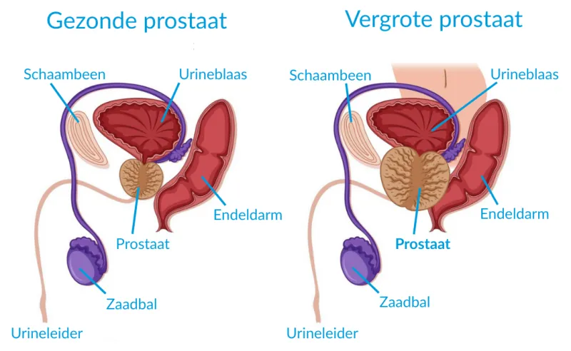 Gezonde vs vergrote prostaat